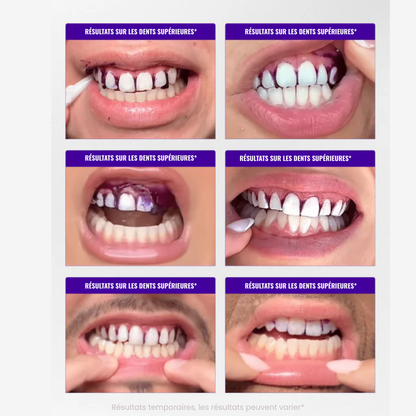 Bandes de blanchiment dentaire - Zelya™ Zelya